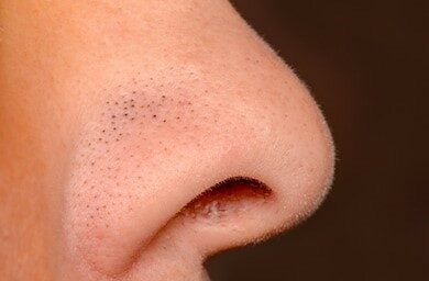 blackheads-on-nose